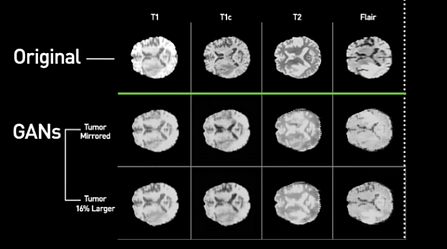 Immagine di una scansione MRI di un certo tipo di tumore al cervello. In alto l'immagine originale e in basso le immagini riprodotte con la tecnologia GAN 