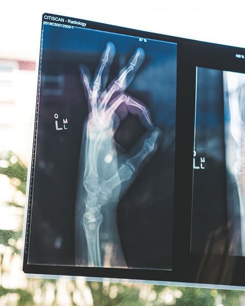 Fotografia ritraente una radiografia di una mano